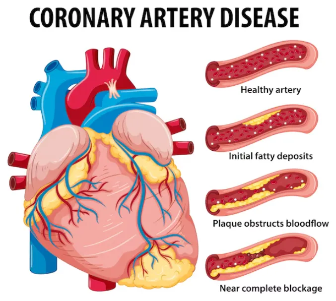 Coronary Artery Disease Treatment in Chennai – Exp...