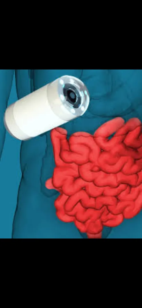 Capsule endoscopy is a non-invasive medical proced...