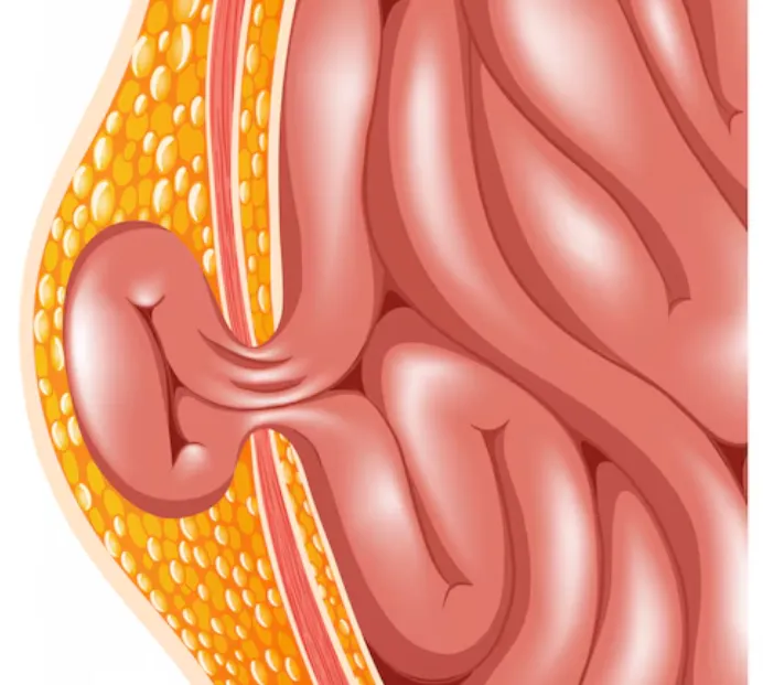 Robotic Hernia Surgery: A Safer Option in Peenya R...