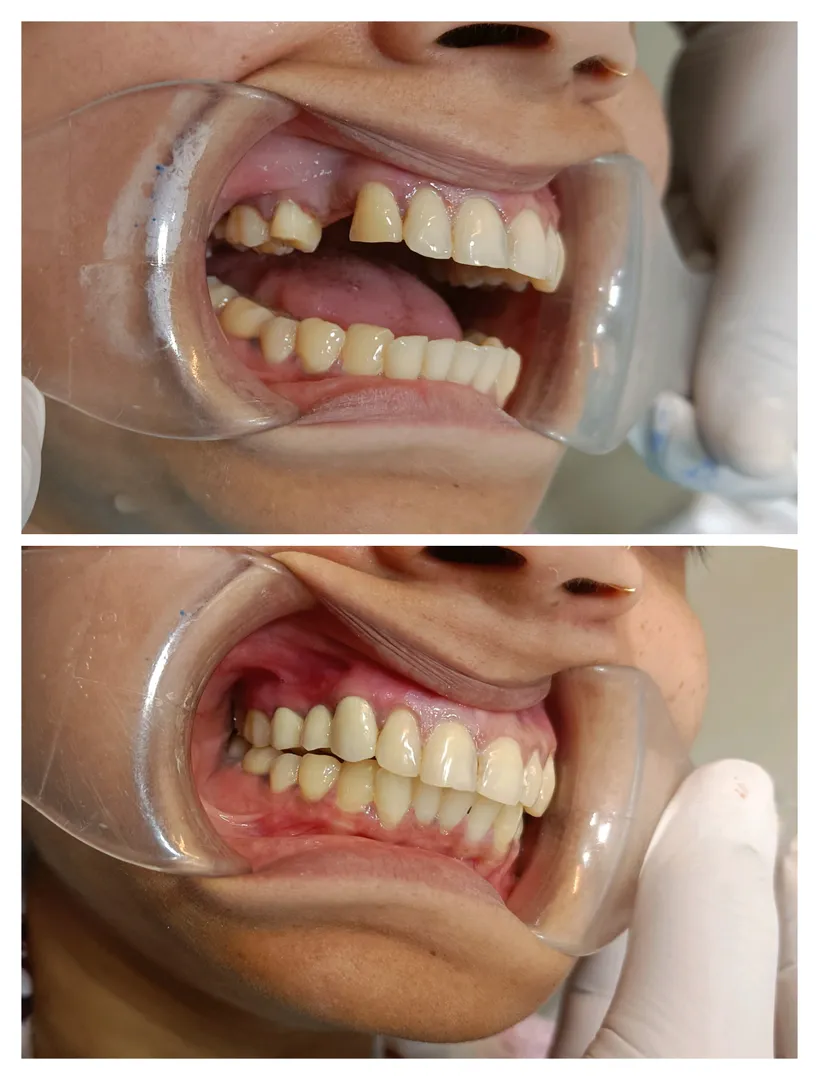 Case Presentation: PFM Crown for Premolar Replacem...