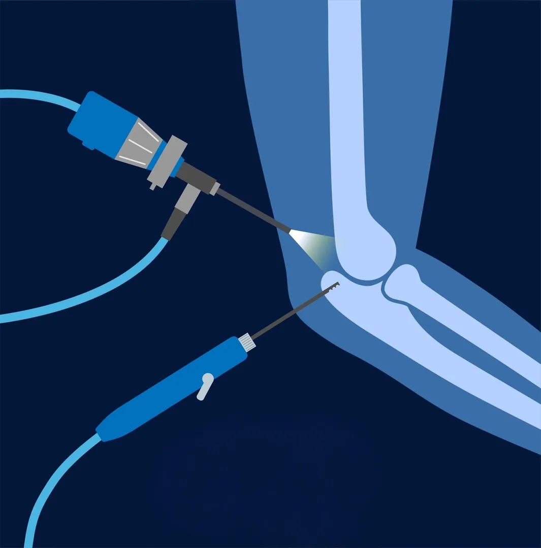 Best Elbow Joint Arthroscopy and Replacement in Ba...