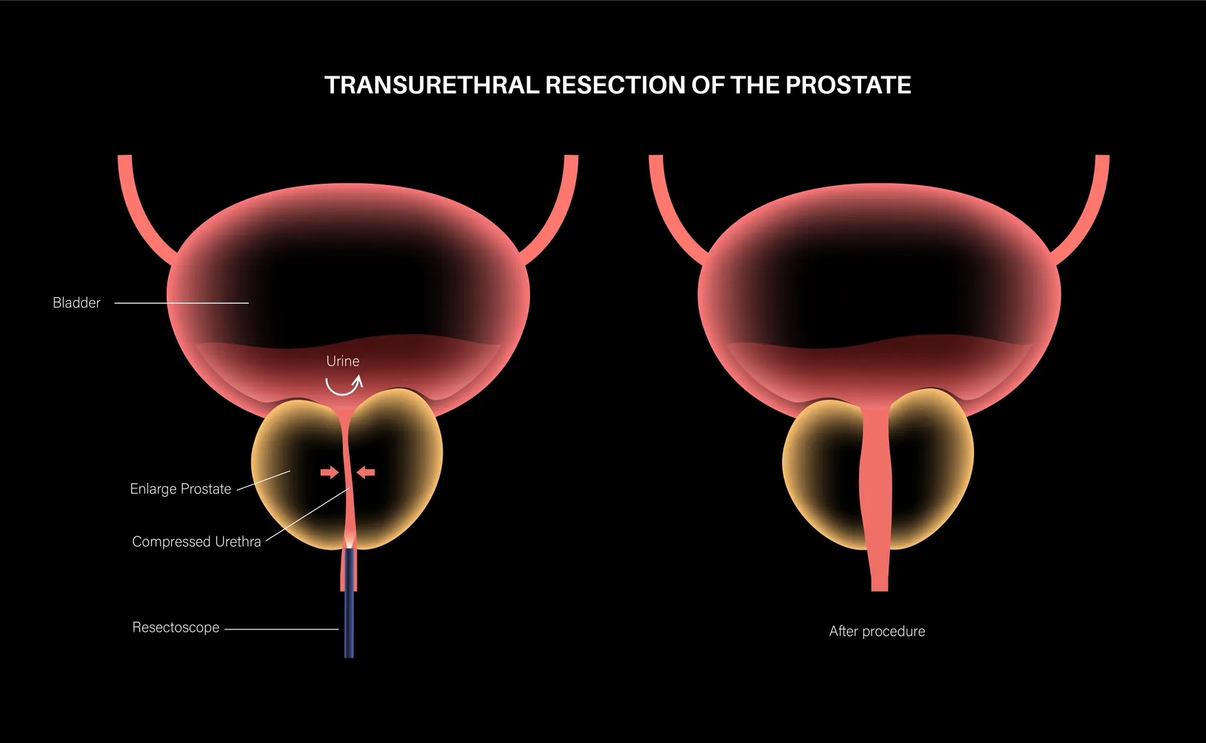 TURP in Charai, Thane West – Advanced Prostate Sur...