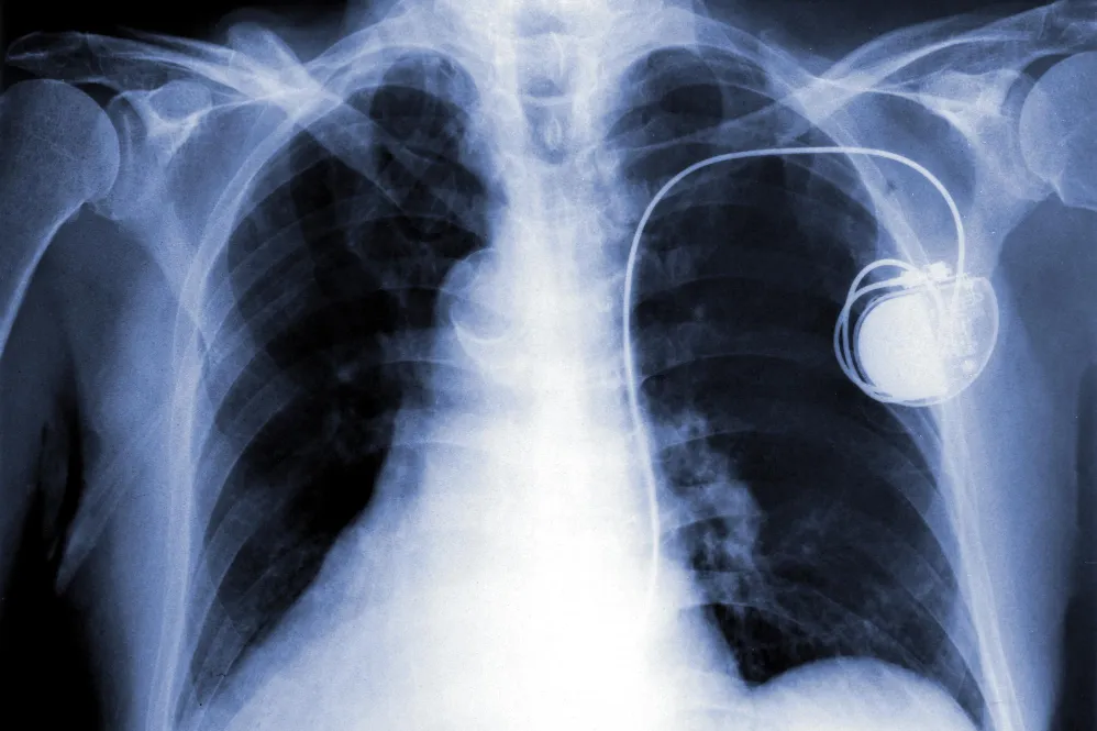Pacemakers in Pune: Advanced Solutions for Heart R...
