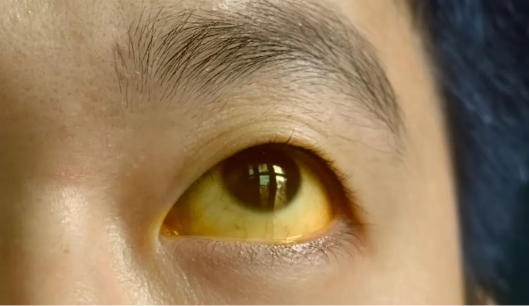 JAUNDICE IN ADULTS – SURGICAL CAUSES AND TREATMENT...