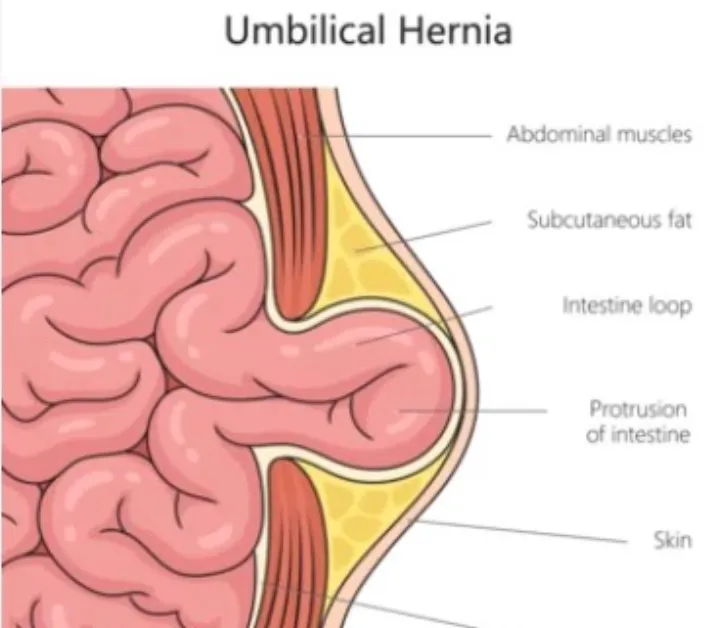 Robotic Umbilical Hernia Surgery in Yeshwantpur Um...