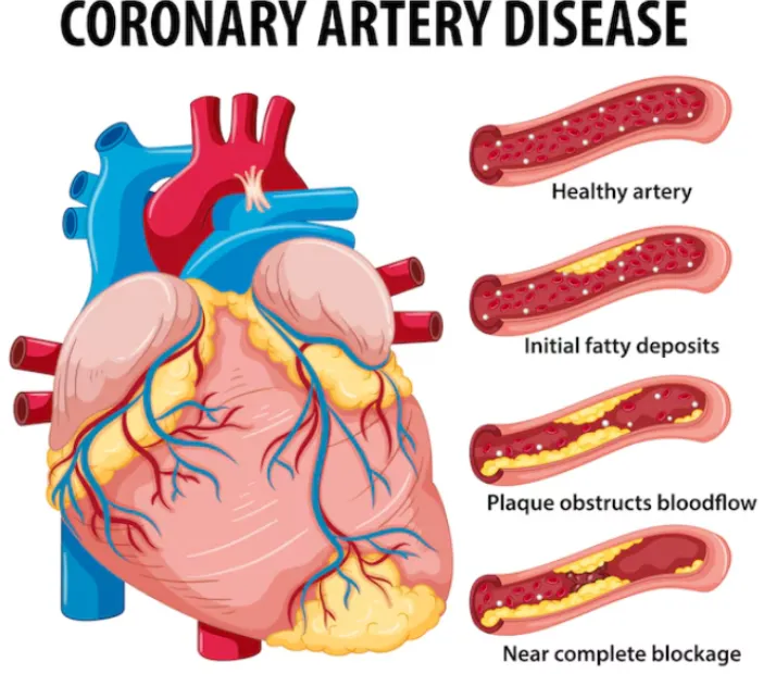 Expert Care for Coronary Artery Disease in Chennai...
