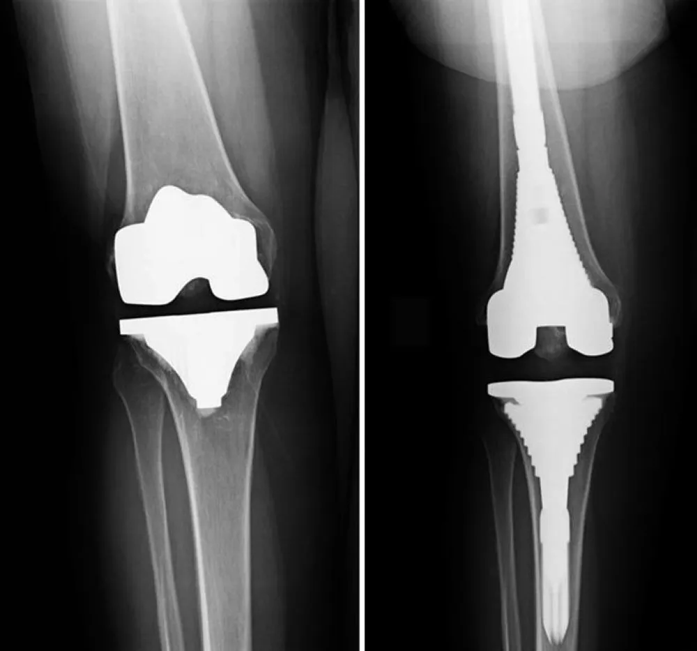 Best Revision Knee Replacement in Bangalore – A Se...