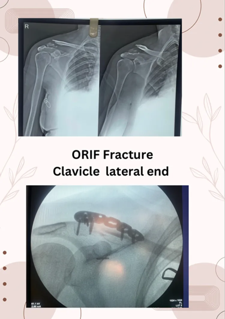FRACTURE LATERAL END CLAVICLE OPERATED SUCCESSFULL...