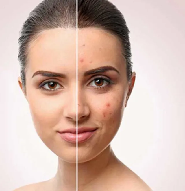 Acne Treatment in Dwarka
One of the common types ...