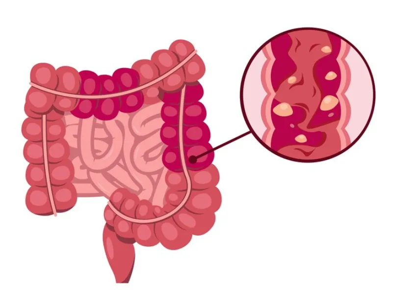 Comprehensive Care for Ulcerative Colitis in Mumba...