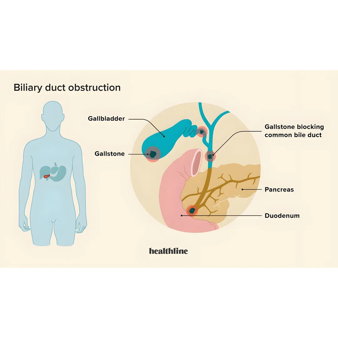 Biliary Obstruction Due to Gallstones: Best Gastro...