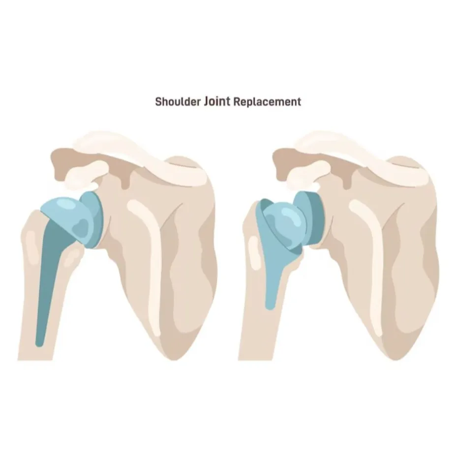 Best Primary Total Shoulder Replacement in Bangalo...