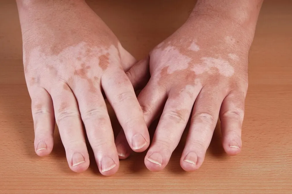 Best Homoeopathic Clinic for Vitiligo in Wagholi V...