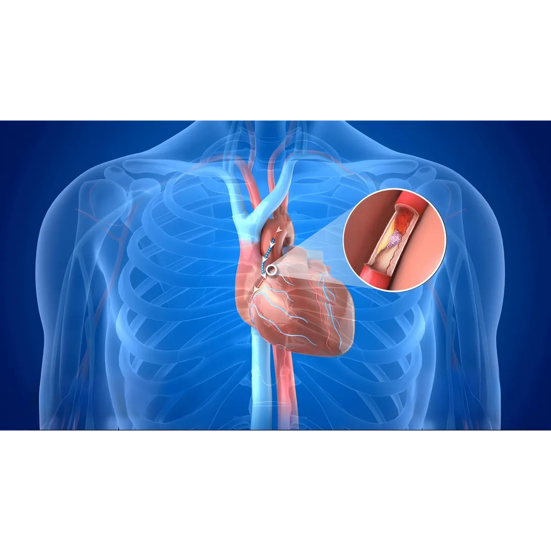 Coronary Bypass Surgery in Pune: Restoring Heart F...