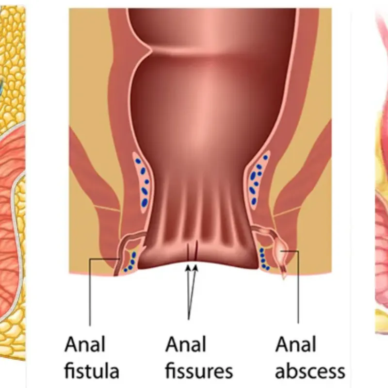 Best Fissure Specialist in Mumbai – Get Quick Reli...