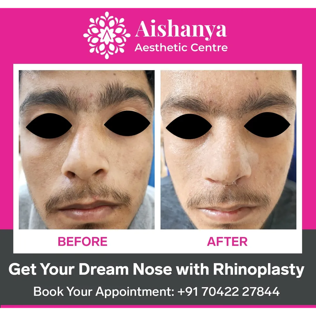 Nose Job in Dwarka
A nose job, also known as rhin...
