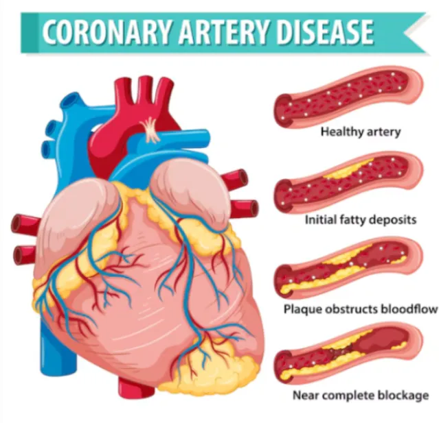 Coronary Artery Disease Treatment in Chennai Coron...
