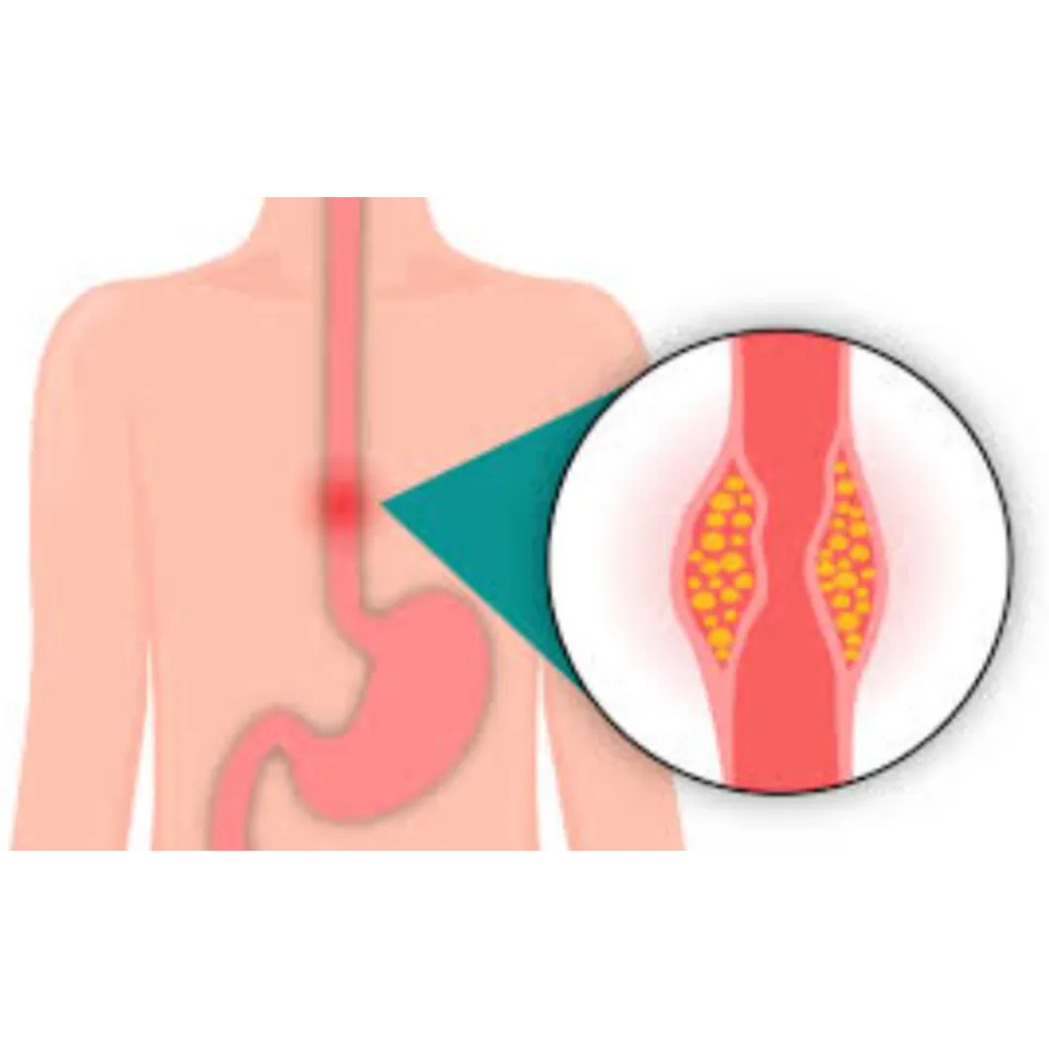 Robotic Esophageal Cancer Surgery in Nagasandra Ro...