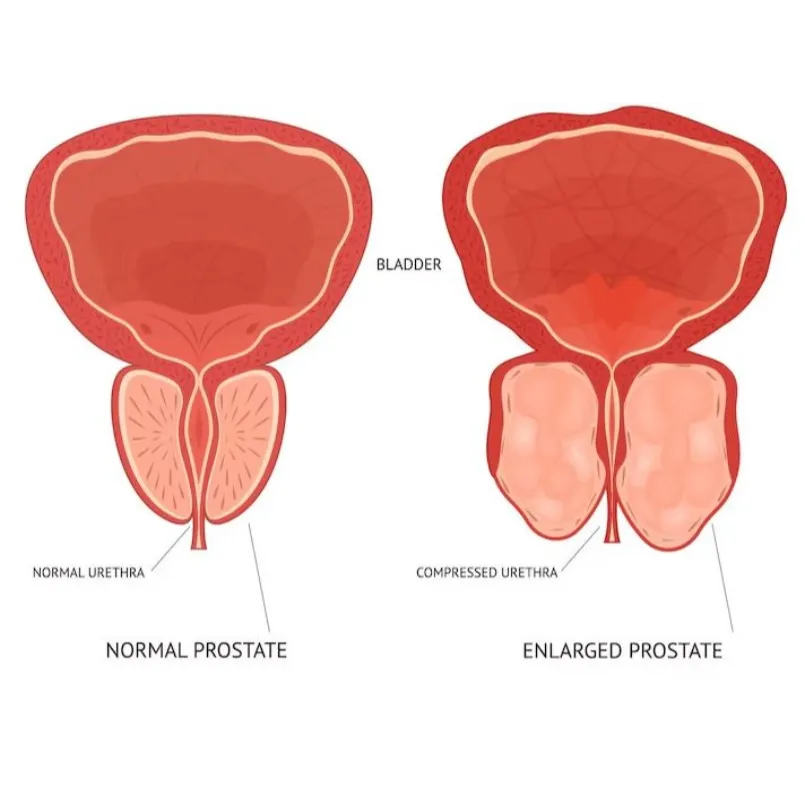 Benign Prostatic Hypertrophy Treatment in Chandanw...