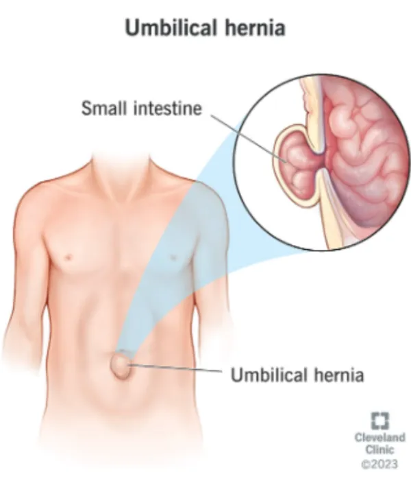 Best Umbilical Hernia Surgery in Nagpur Umbilical ...