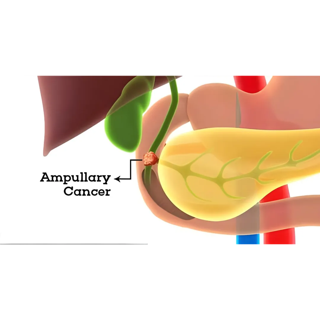 Ampullary Tumors Treatment in Thane, Mumbai What A...