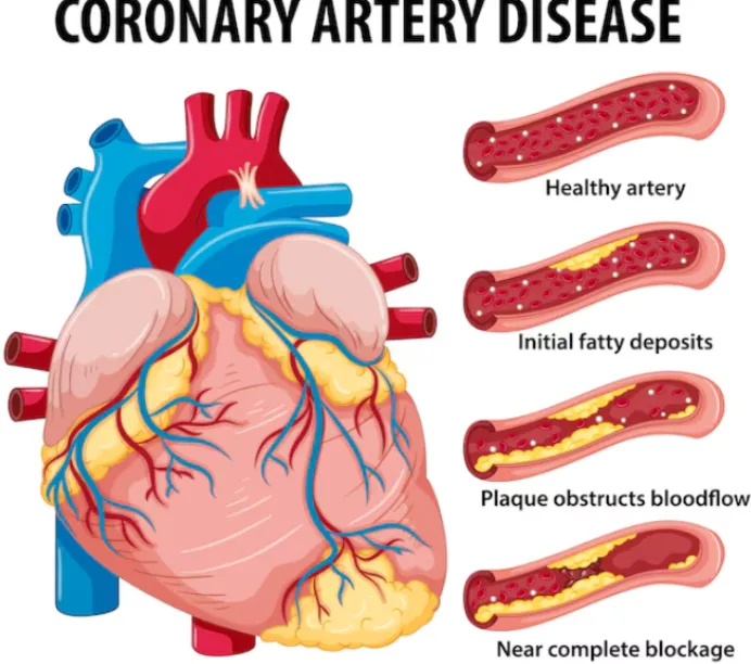 Symptoms of Coronary Artery Disease in Tamil Nadu ...