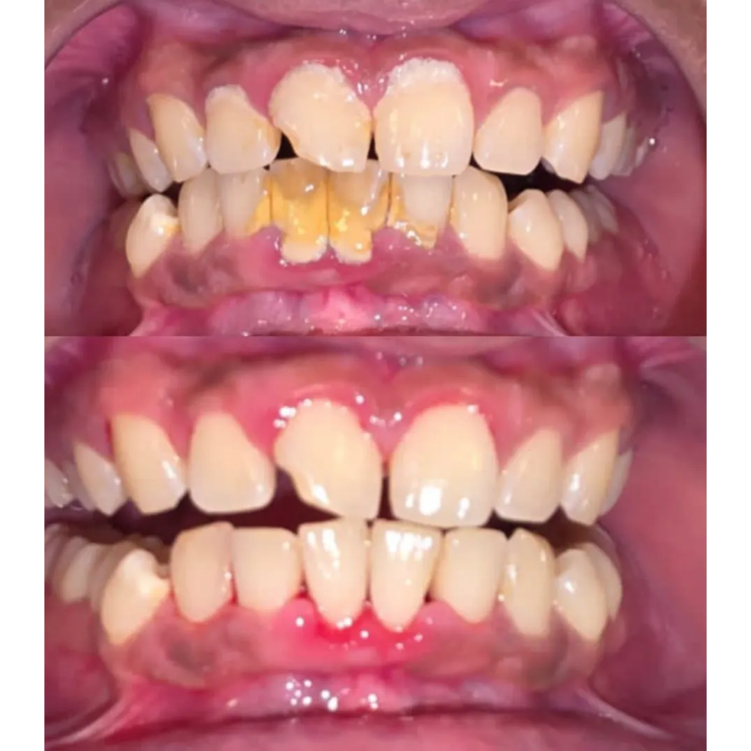 Gum disease
What are the signs? Reddish gums, yel...