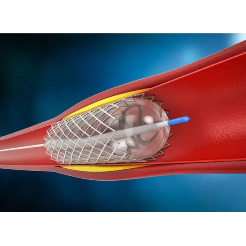 Angioplasty in Pune: Minimally Invasive Treatment ...