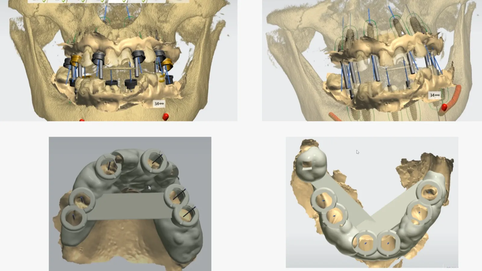 Dental implant planning for our next 'All on X' c...