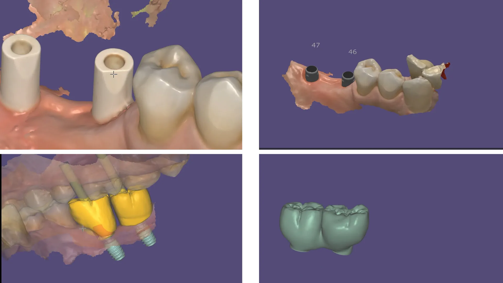Passivity and fit is very important for Implant pr...