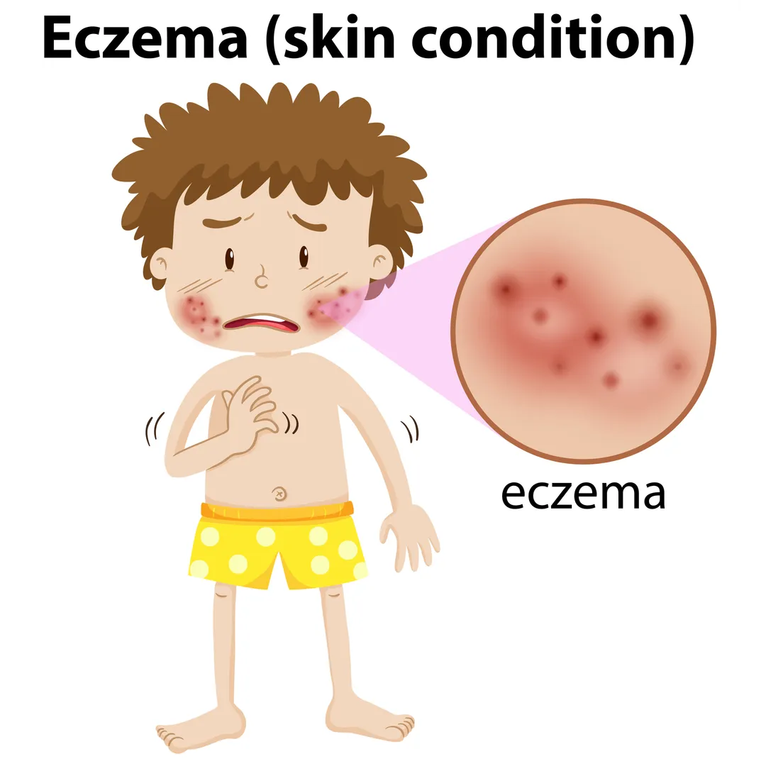 Best Homoeopathic Clinic for Eczema in Wagholi Ecz...