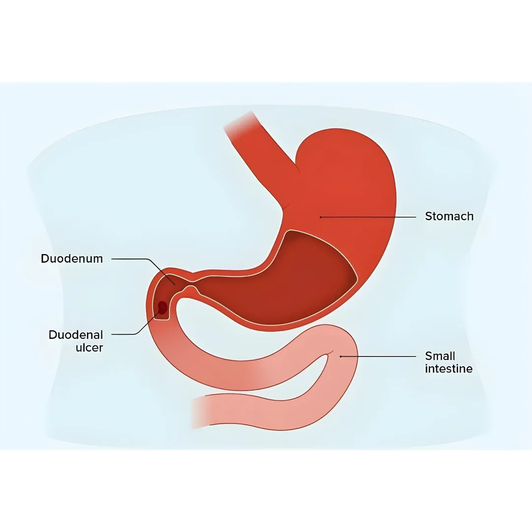 DUODENAL ULCERS: CAUSES AND TREATMENT Duodenal Ulc...