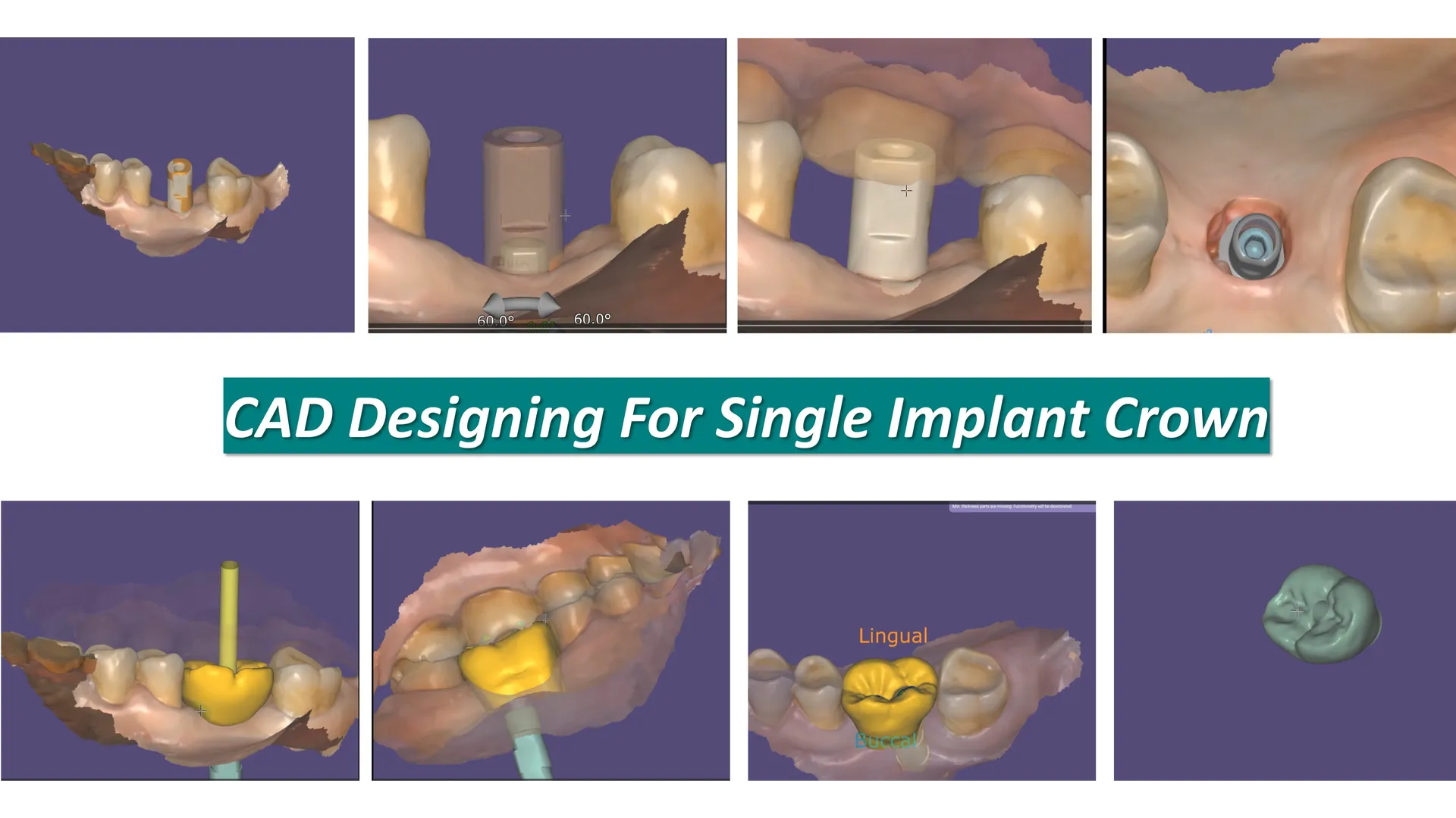 Dental Implant cap designed on CAD software
Digita...