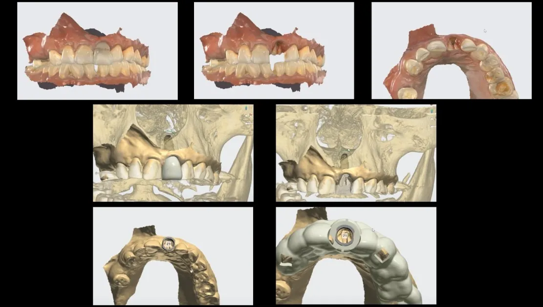 3D Planning for next anterior Implant case
Maxilla...