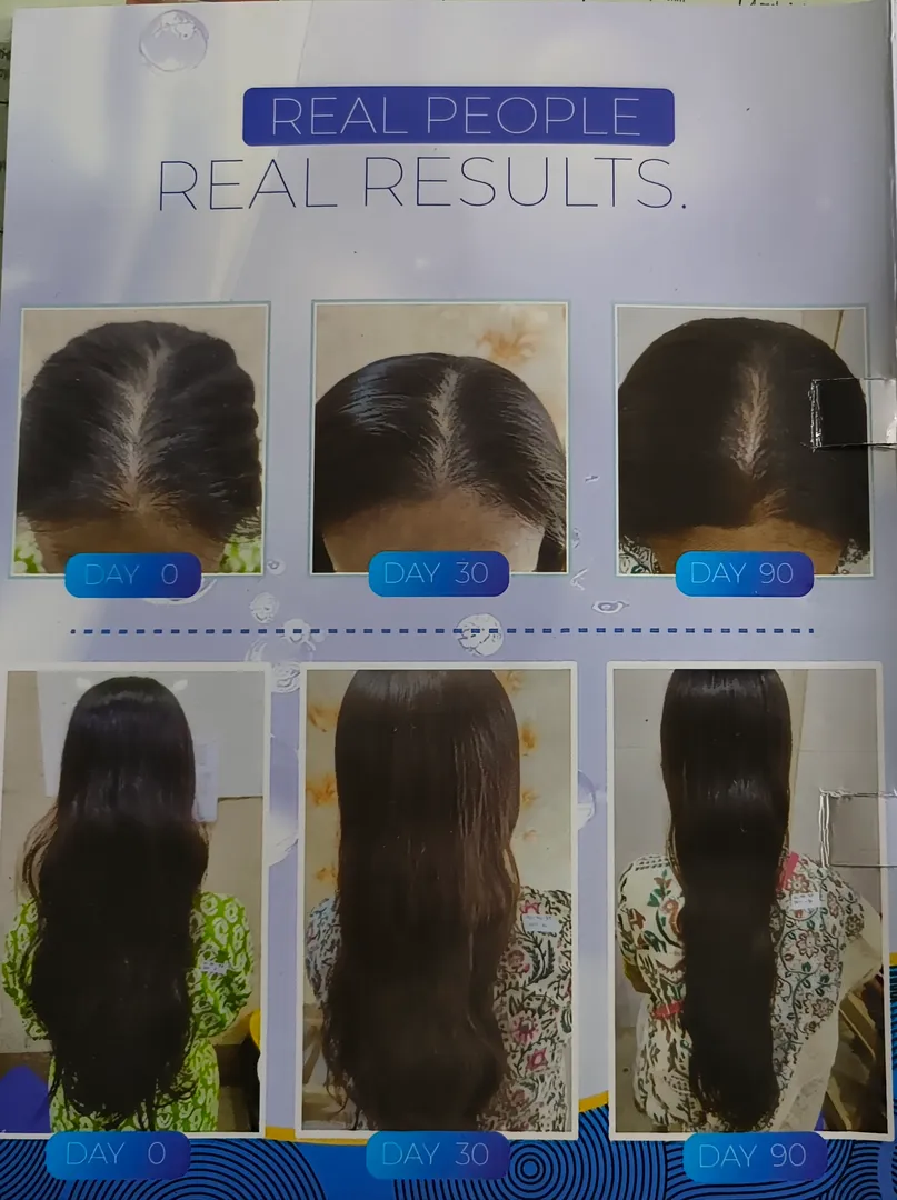 Hair loss takes time and u see visible results wit...