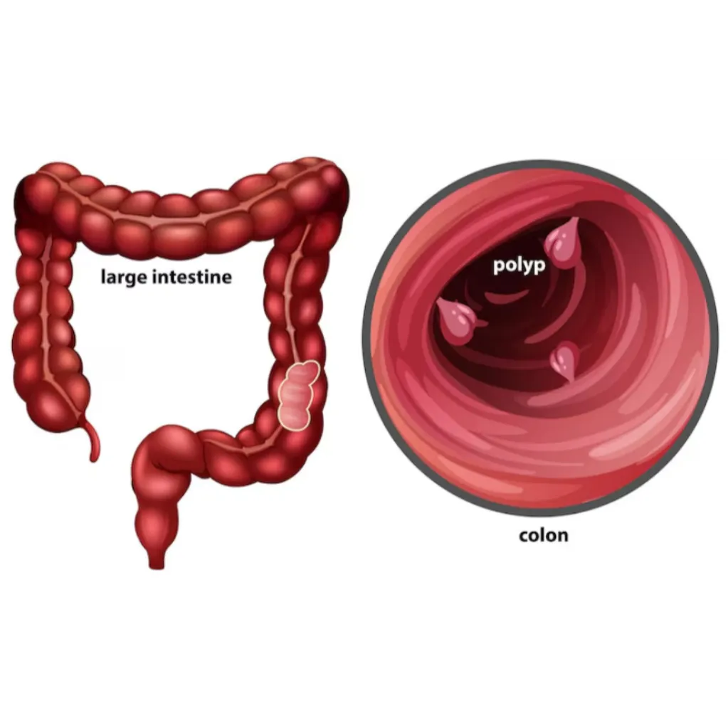 Effective Management of Colonic Polyps in Mumbai C...