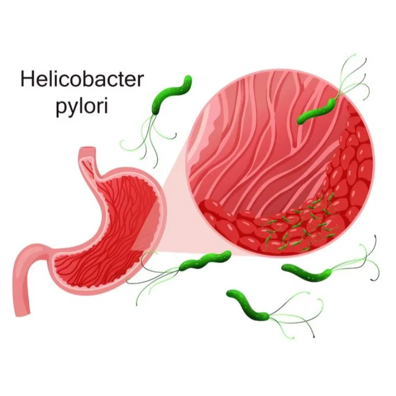 H. pylori Infection and Its Treatment: Gastroenter...