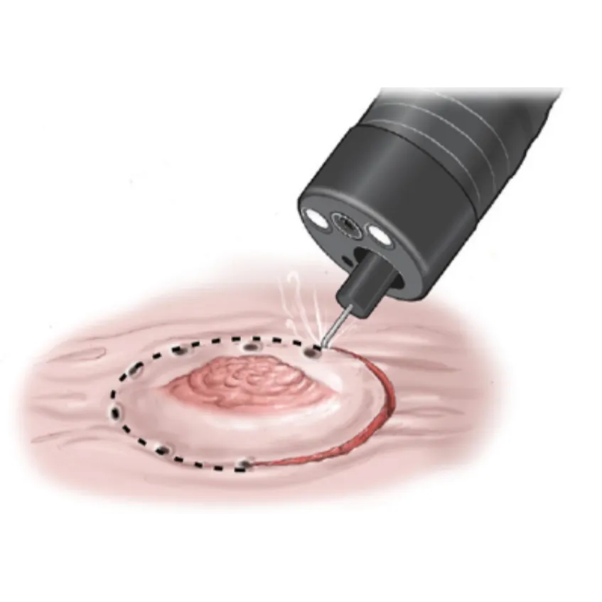 Advanced Endoscopic Submucosal Dissection (ESD) in...