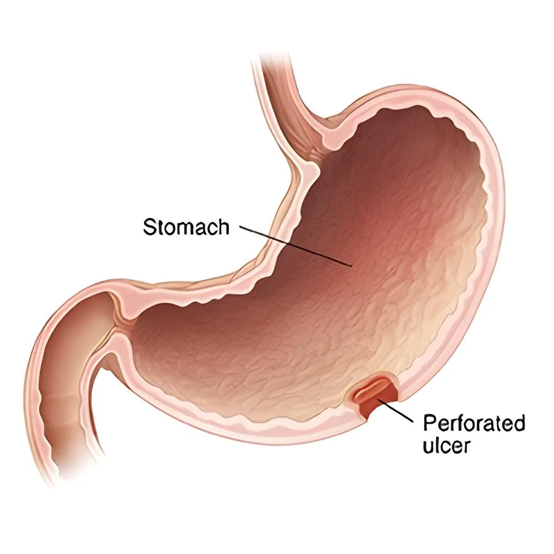 Ulcer Perforation: Symptoms and Surgery: Best Gast...