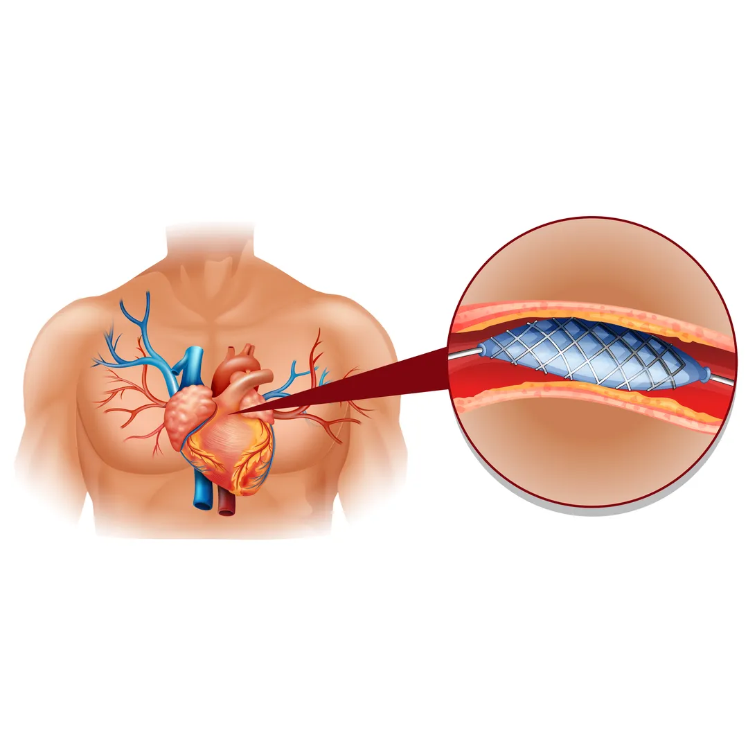 Endovascular Procedures in Pune: A Minimally Invas...