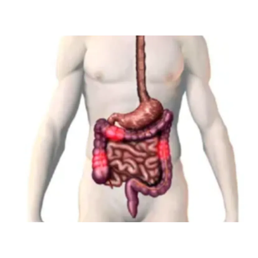Irritable Bowel Syndrome (IBS) Relief in Mumbai Ir...