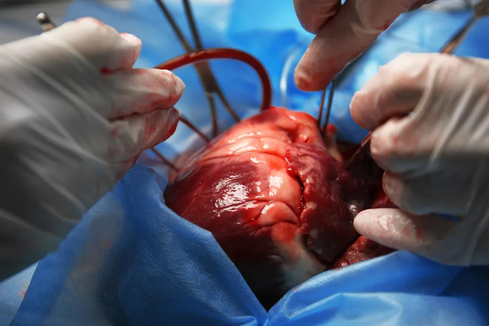 Beating Heart Bypass Surgery in Nagpur Beating Hea...