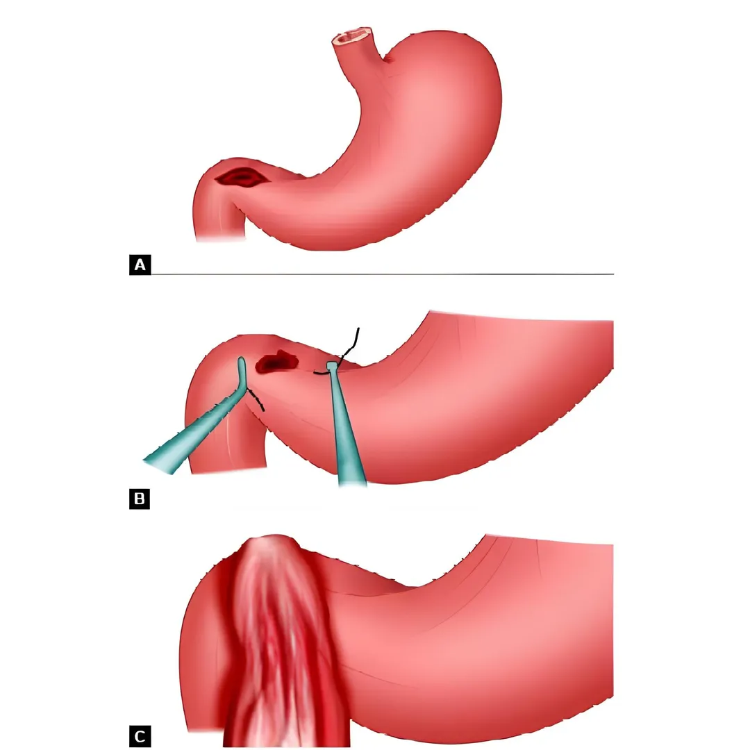 Laparoscopic Repair of Duodenal Ulcer Perforation:...