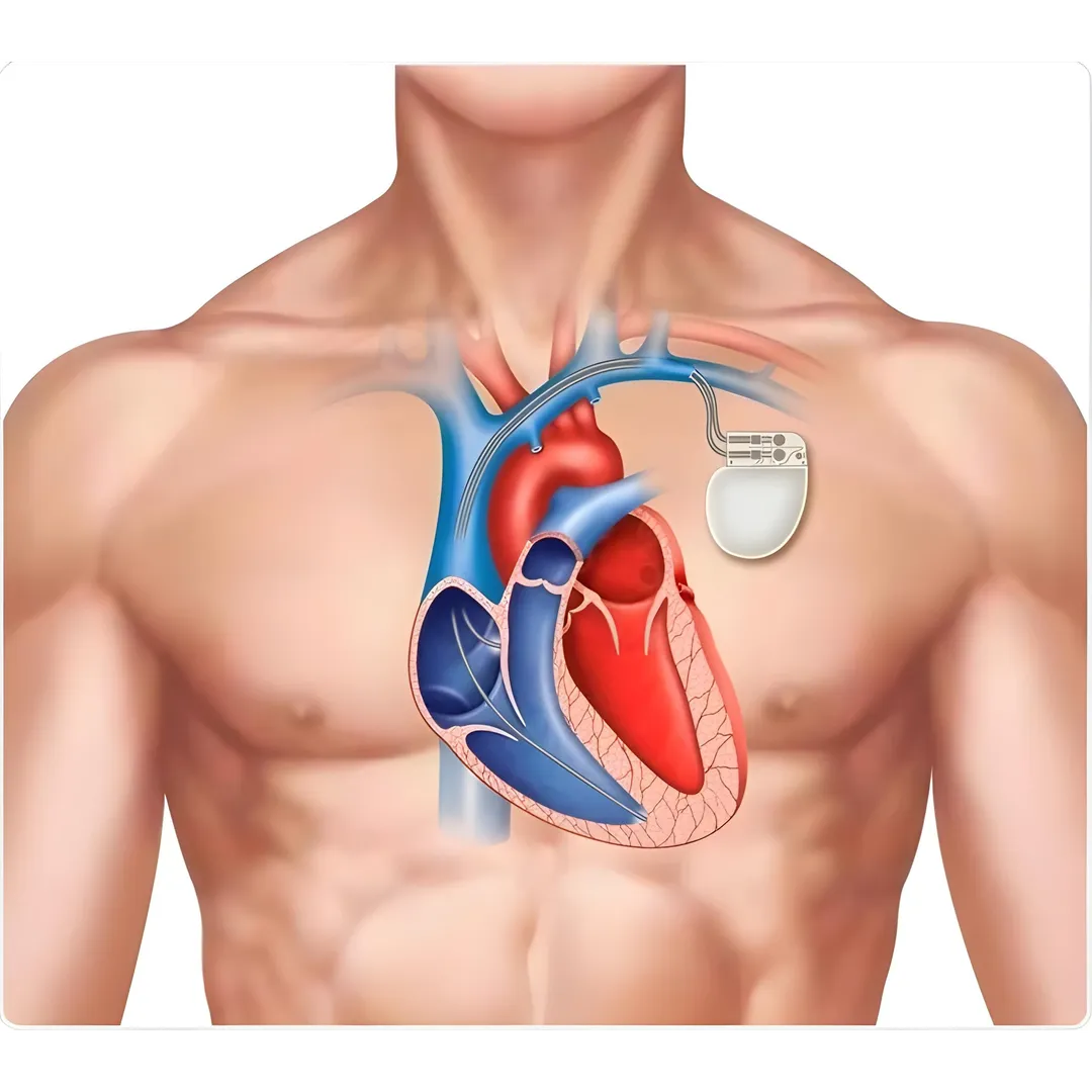 Pacemakers in Pune: Restoring Rhythm, Enhancing Li...