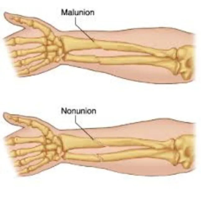 Nonunion and Malunion Treatment in Pimpri Chinchwa...