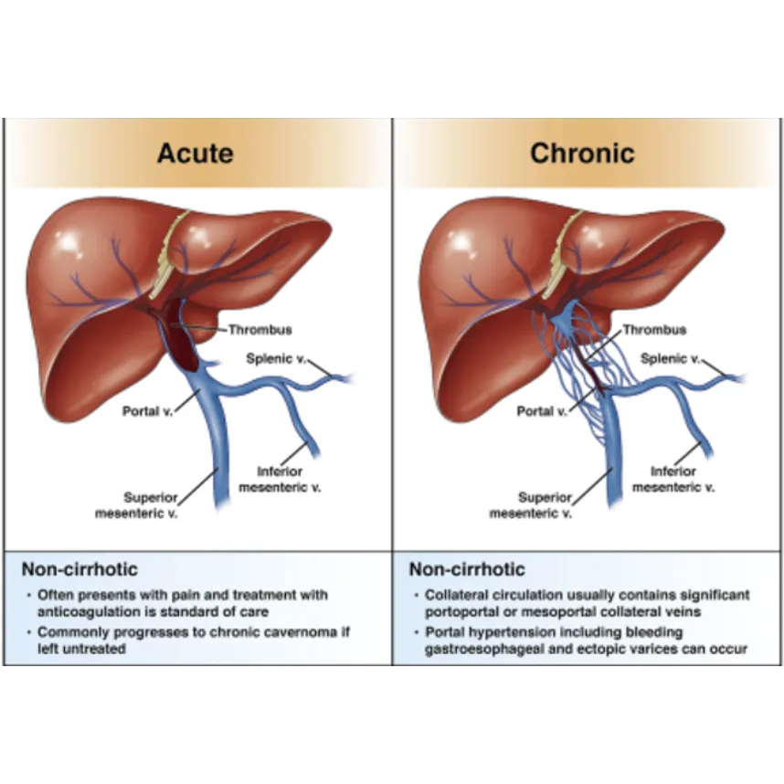 Learn about managing portal vein thrombosis in non...