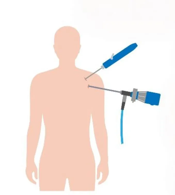 Shoulder Arthroscopy in New Thippasandra, Bengalur...