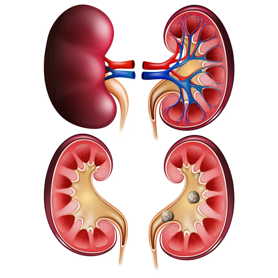 Best Kidney Stone Treatment in Thane West – Non-Su...