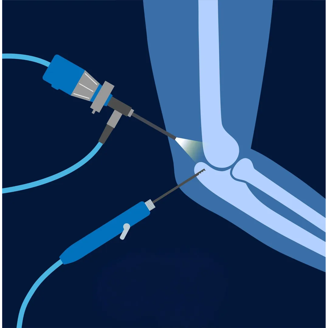 Elbow Joint Arthroscopy and Replacement in New Tip...
