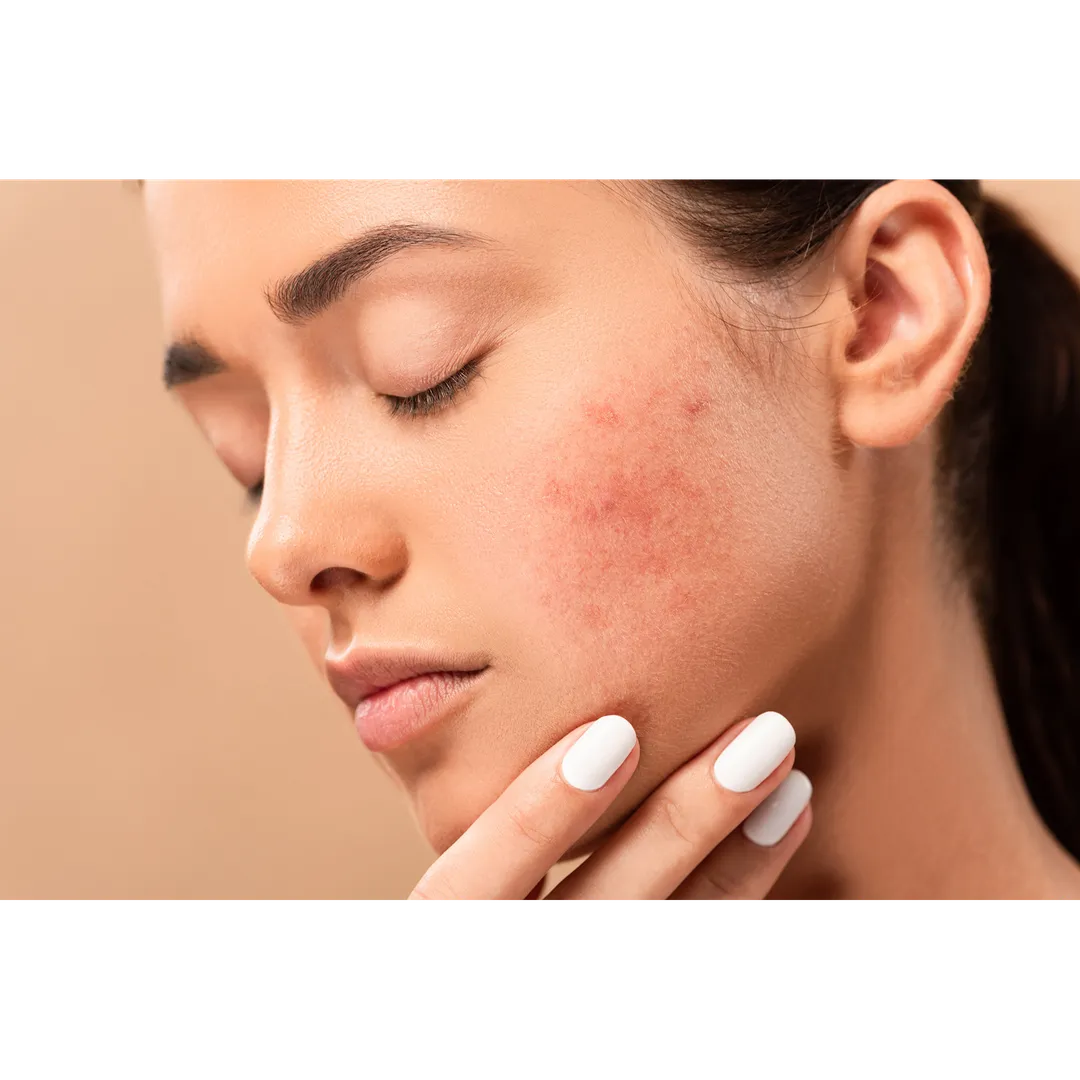 Acne Treatment in Dwarka
One of the Common Types ...